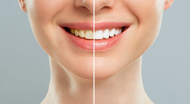 before and after Teeth Whitening