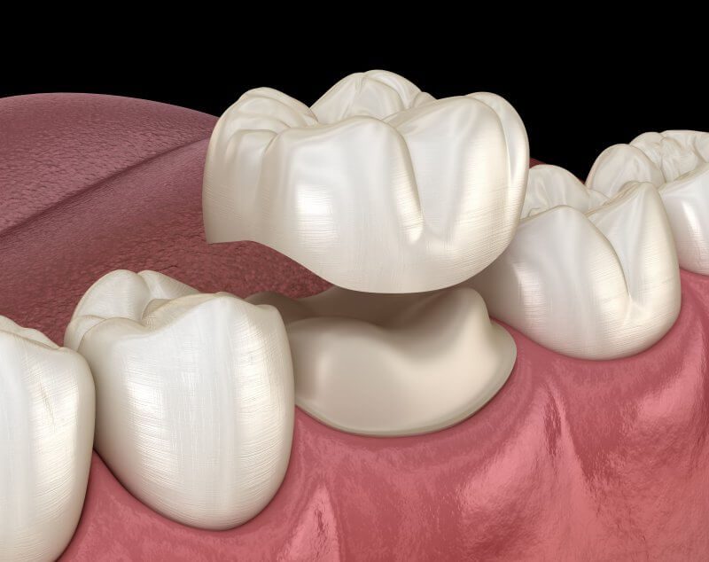 dental crown placement.