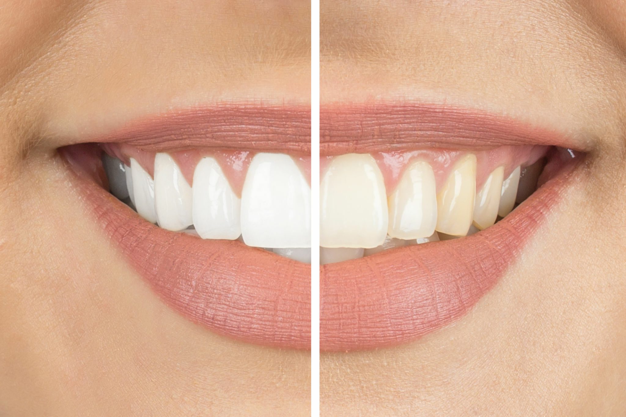 How Much Is Teeth Whitening UK?