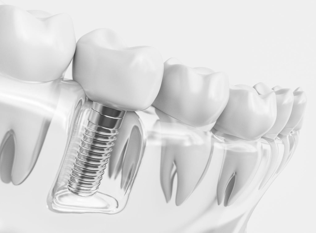 Guidance on the standards of care for NHS-funded dental implant