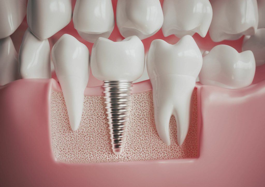 Implant