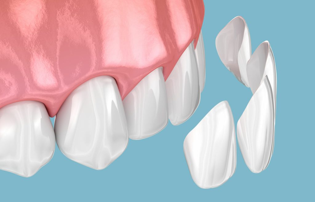 Positeethâ® 3d Bonding