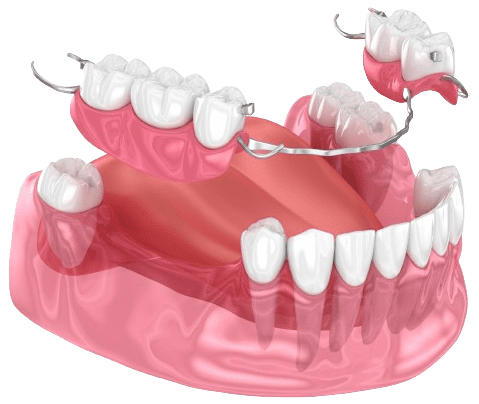 dental implant