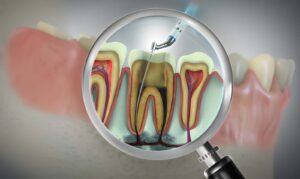 how much does a root canal cost NHS Scotland