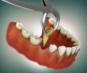 Tooth Extraction Cost on the NHS in Scotland
