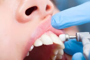 scale and polish dentist Hawick